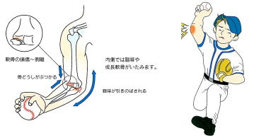 図1. 野球肩・野球肘(日本手の外科学会・エーザイ株式会社のパンフレットより)